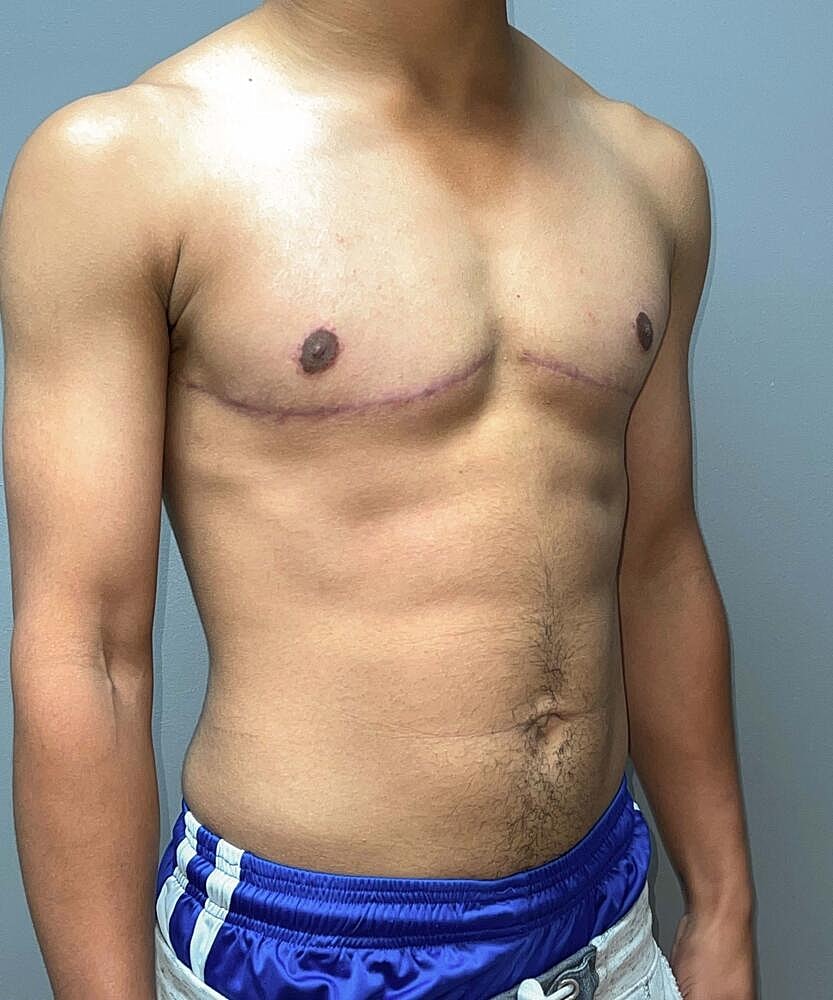 Ftm Top Surgery Before & After