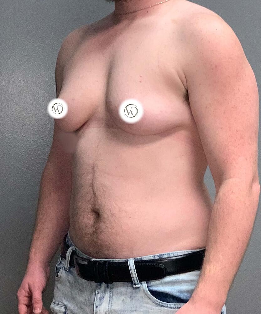 Ftm Top Surgery Before & After