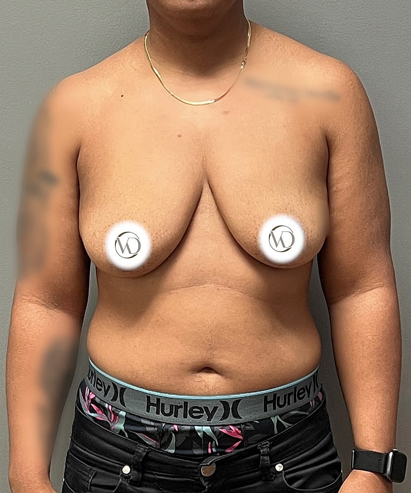 Ftm Top Surgery Before & After
