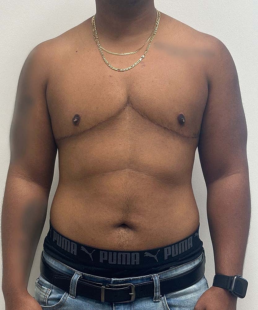 Ftm Top Surgery Before & After
