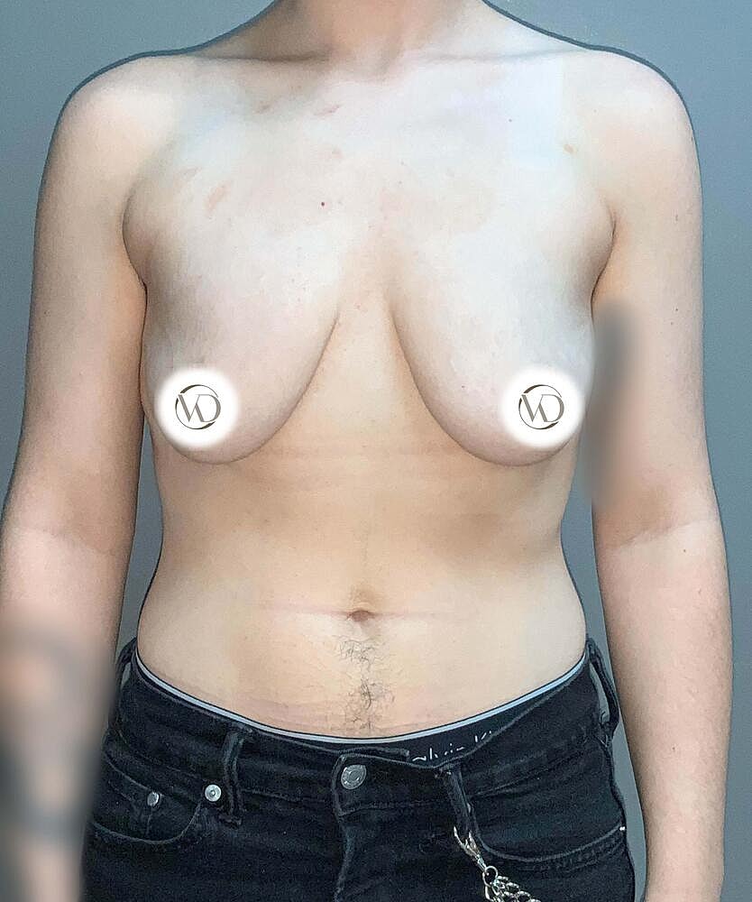 Ftm Top Surgery Before & After