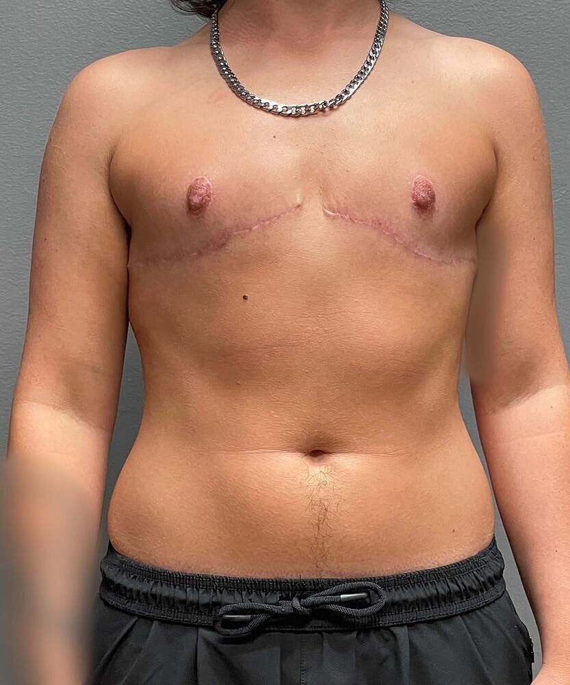 Ftm Top Surgery Before & After