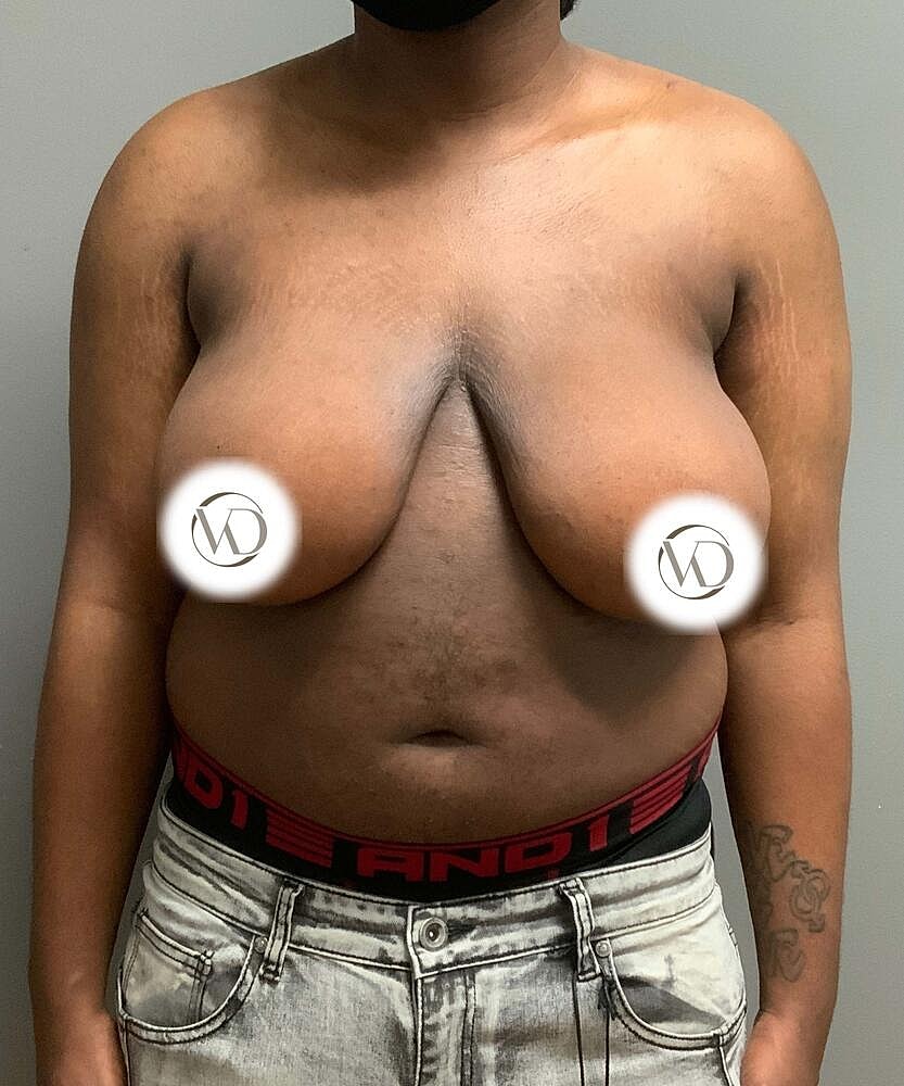 Ftm Top Surgery Before & After