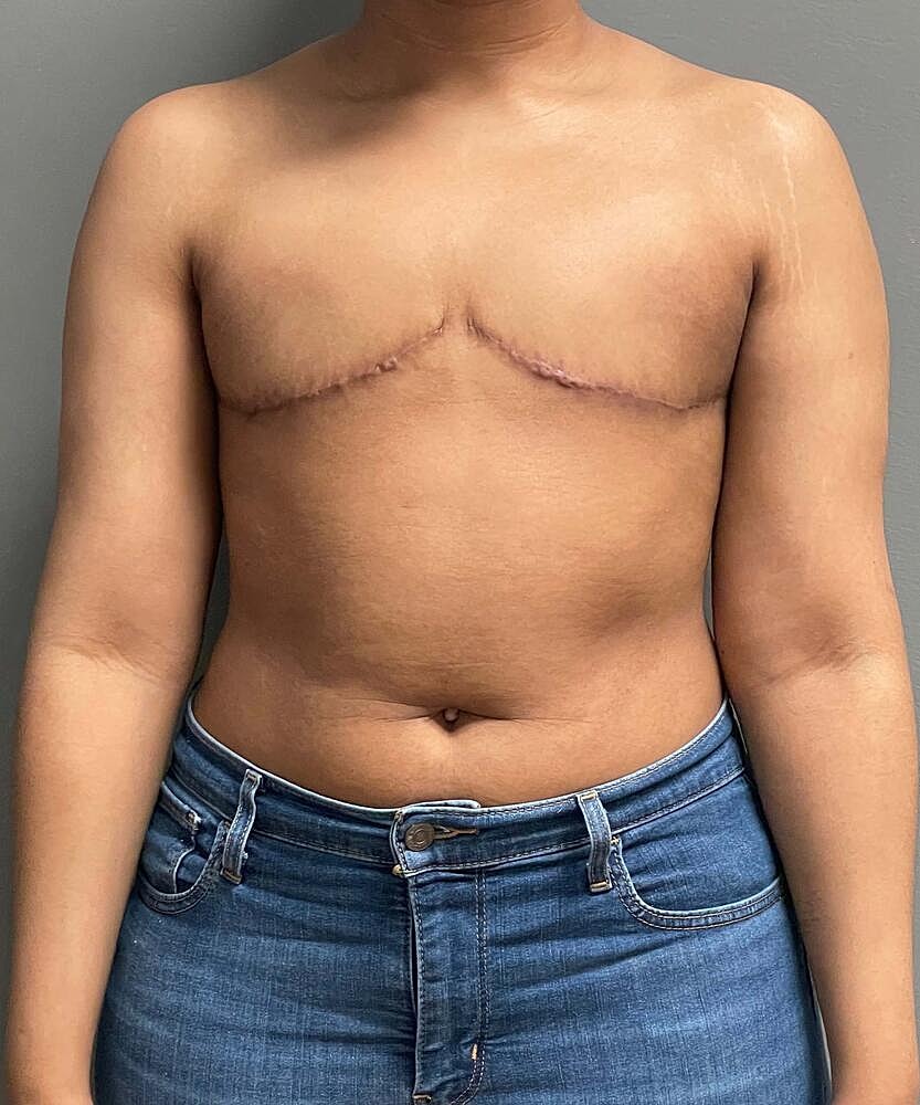 Ftm Top Surgery Before & After