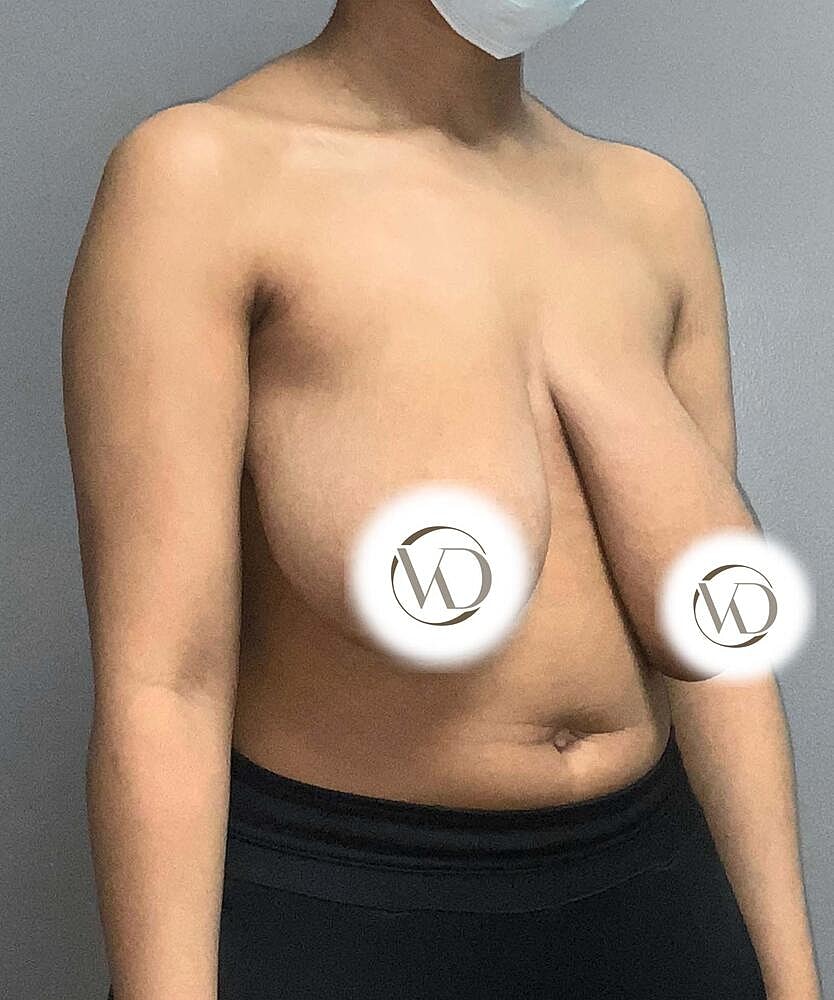 Ftm Top Surgery Before & After