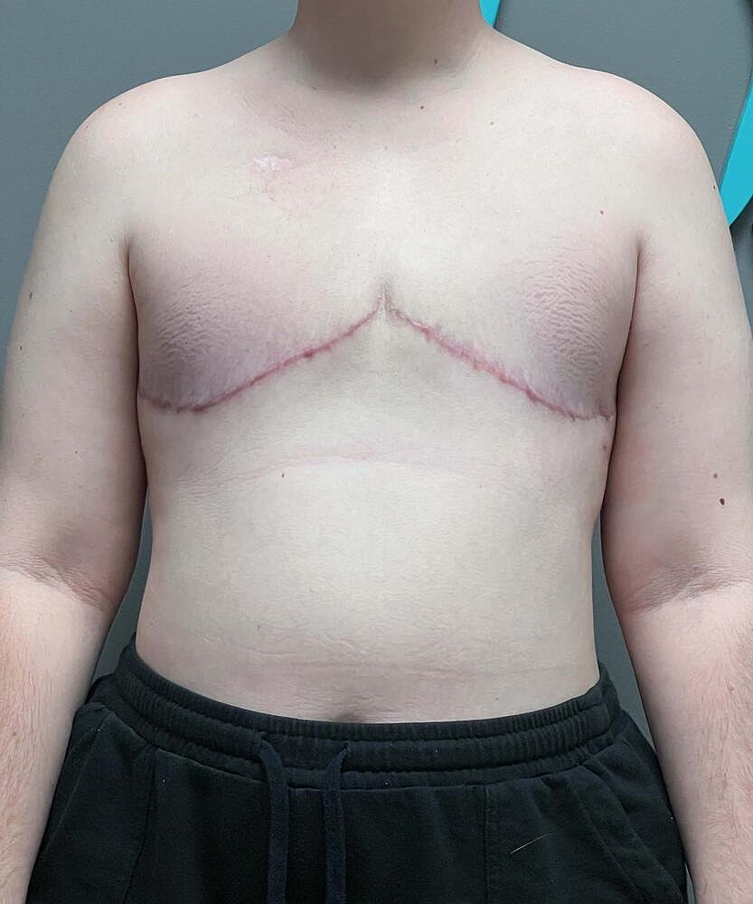 Ftm Top Surgery Before & After