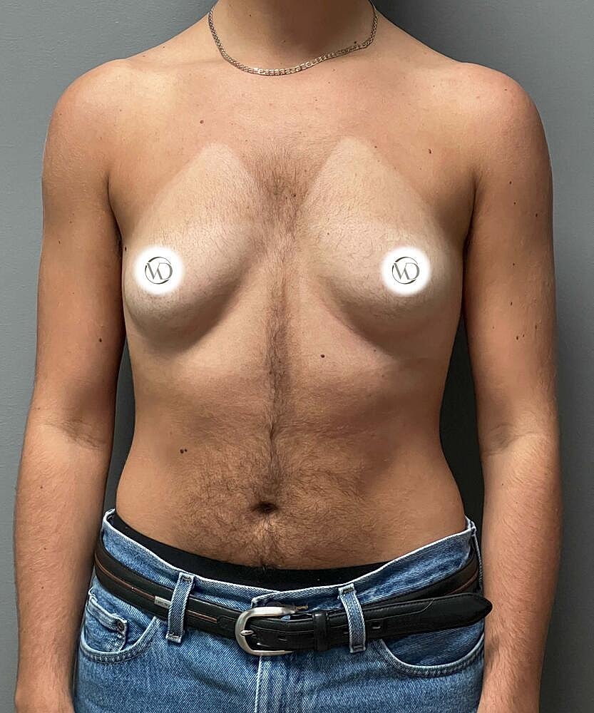 Ftm Top Surgery Before & After