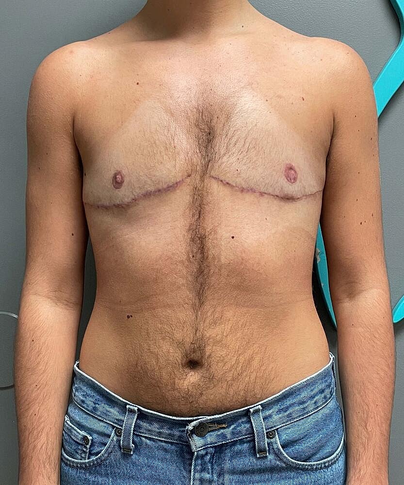Ftm Top Surgery Before & After