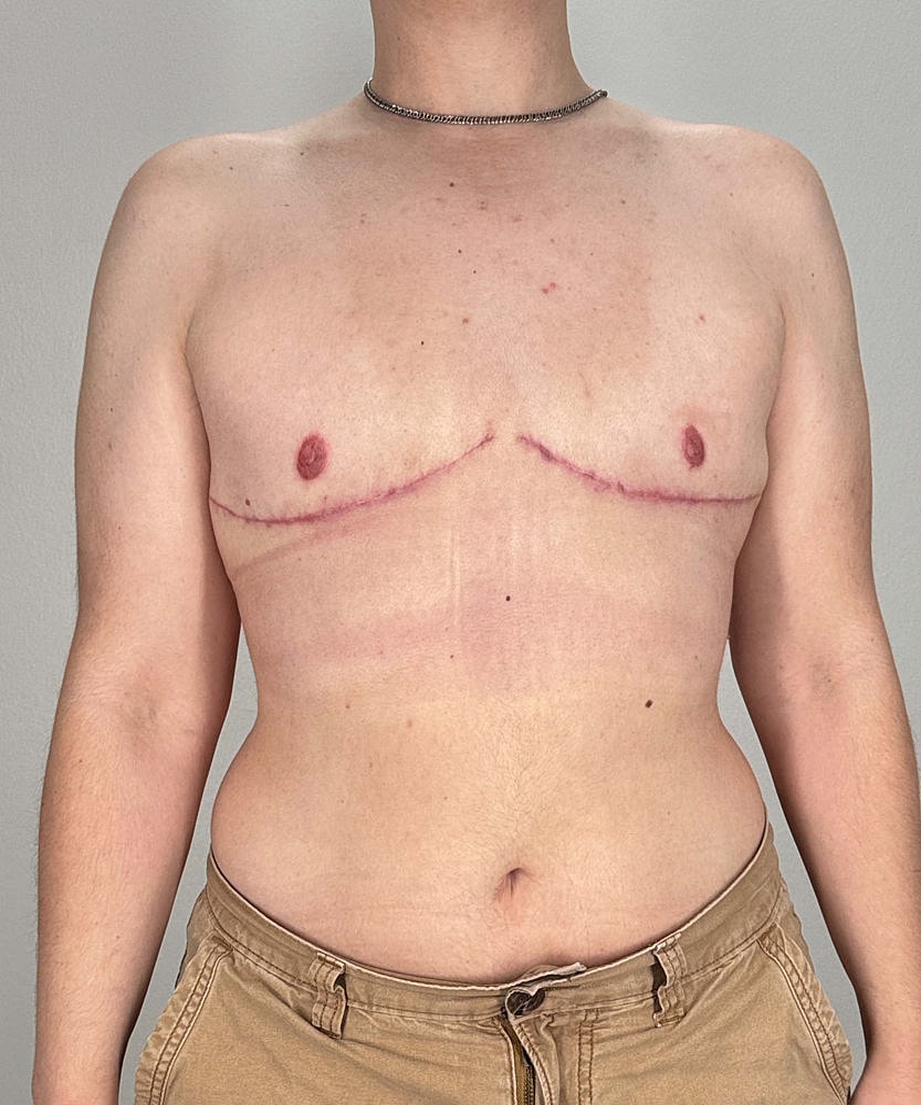 Ftm Top Surgery Before & After