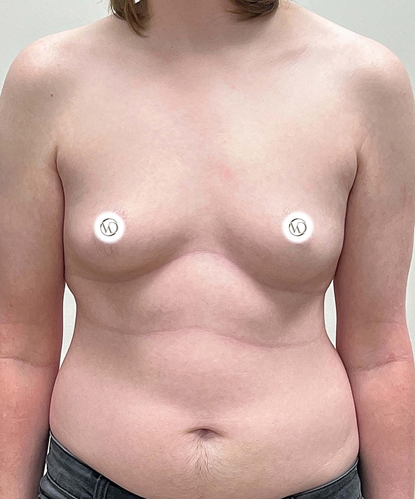 Ftm Top Surgery Before & After