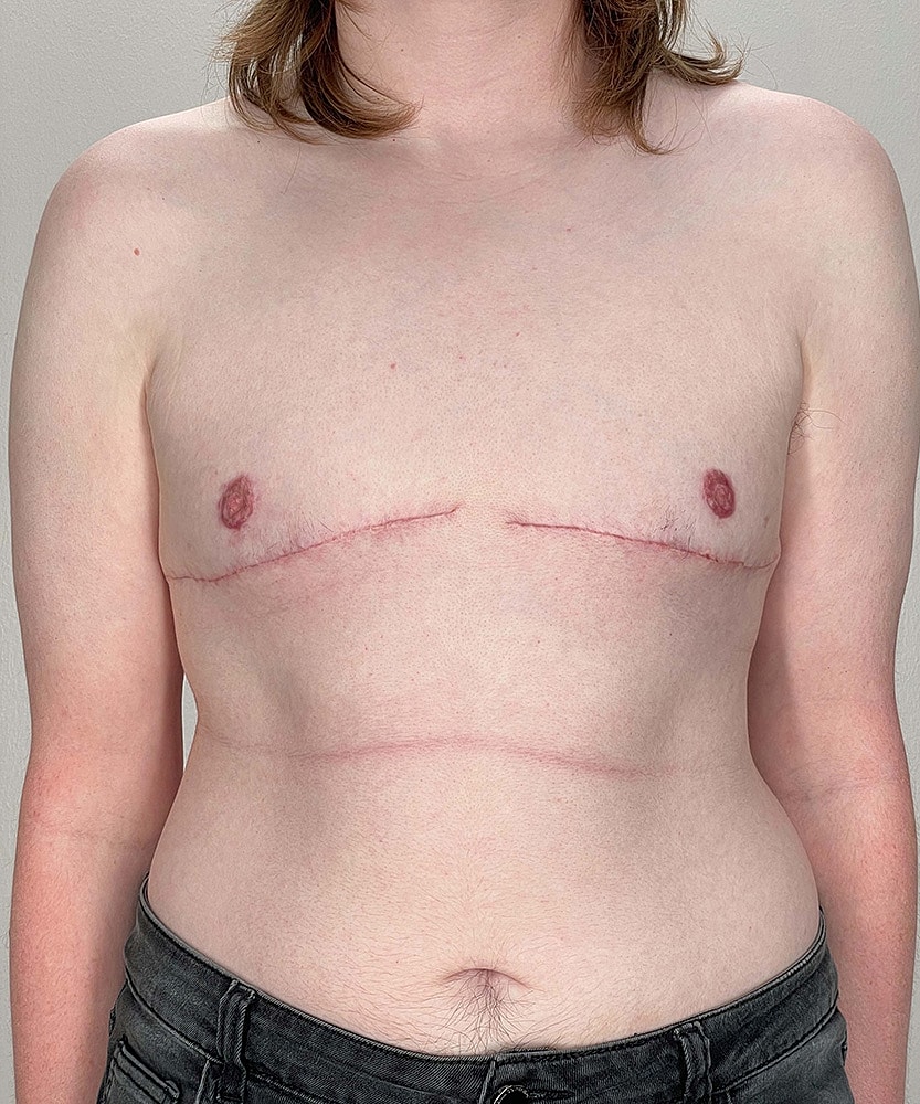 Ftm Top Surgery Before & After