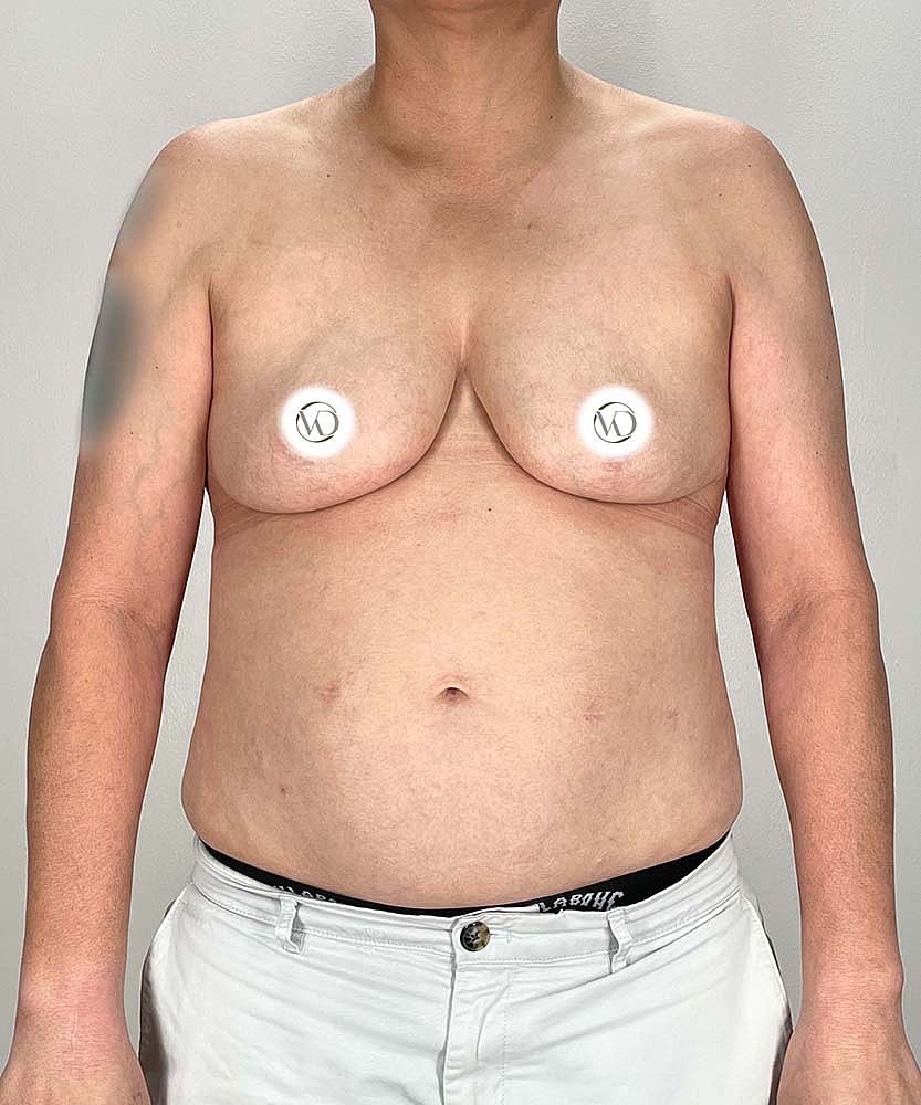 Ftm Top Surgery Before & After