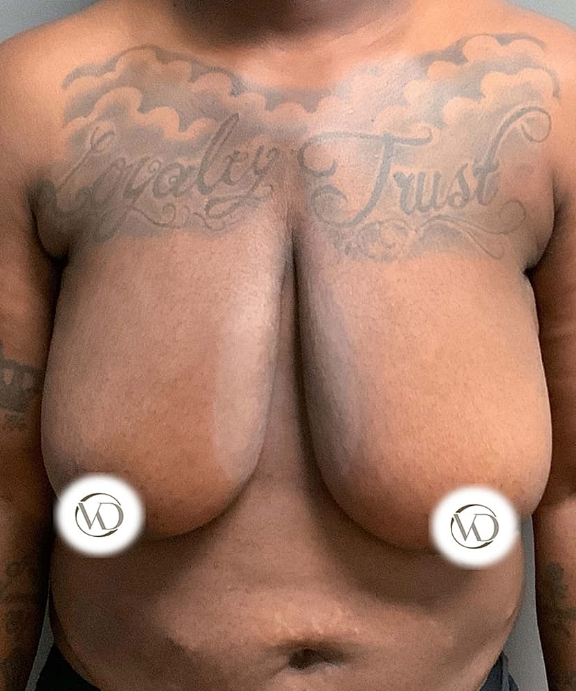 Ftm Top Surgery Before & After