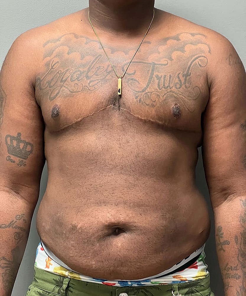Ftm Top Surgery Before & After