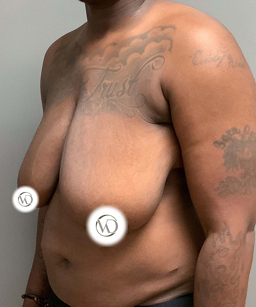 Ftm Top Surgery Before & After