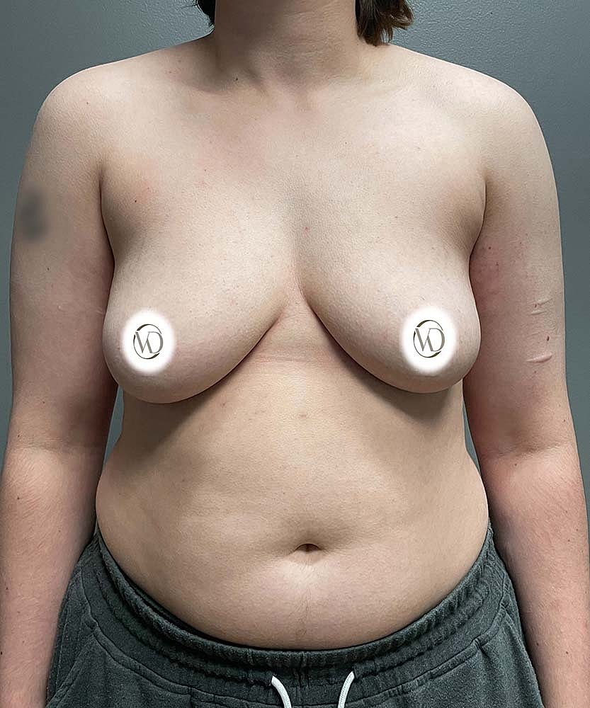 Ftm Top Surgery Before & After