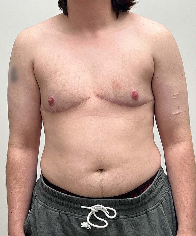Ftm Top Surgery Before & After
