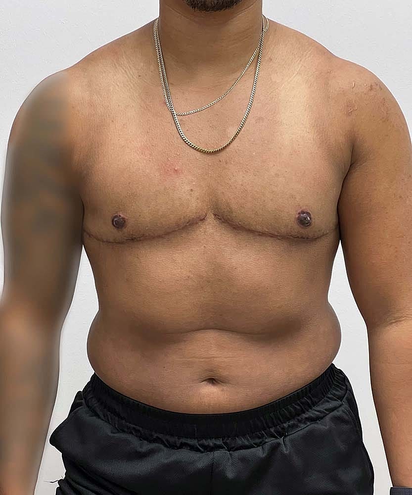 Ftm Top Surgery Before & After
