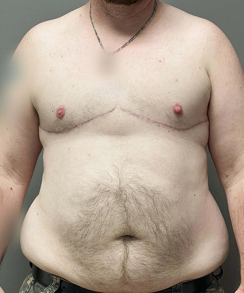 Ftm Top Surgery Before & After