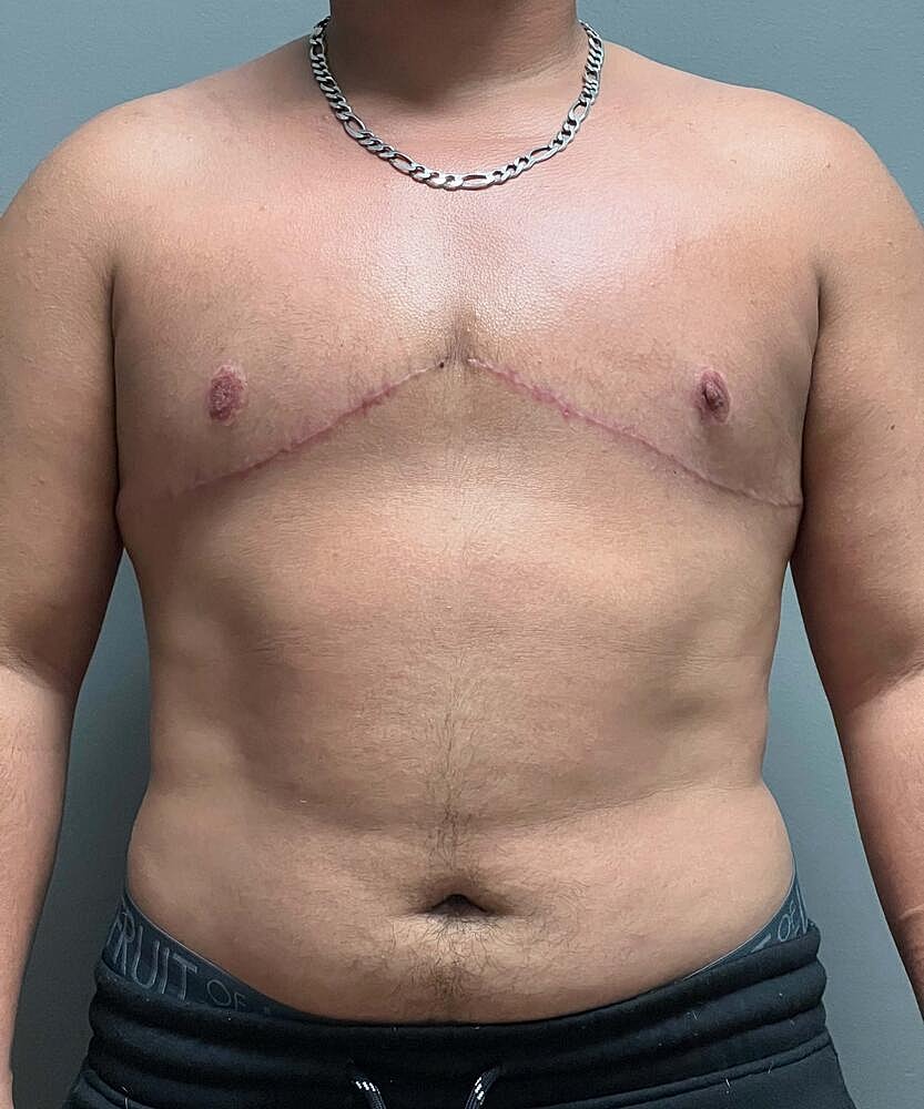 Ftm Top Surgery Before & After