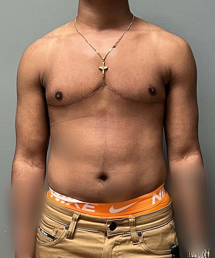 Ftm Top Surgery Before & After