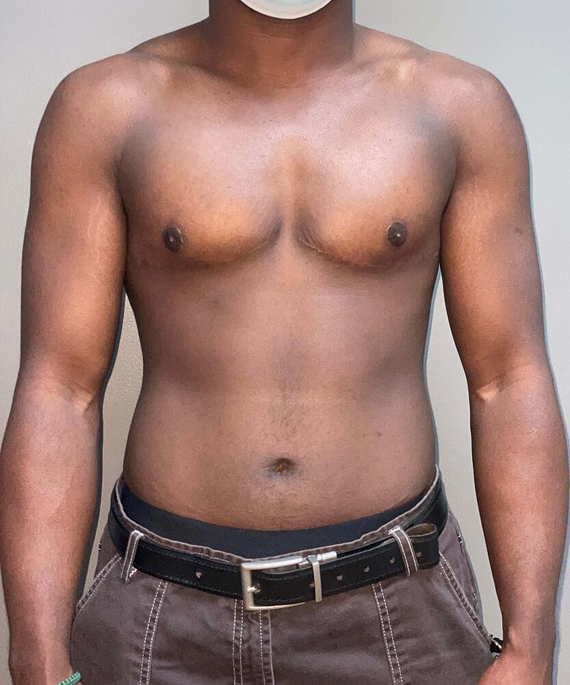 Ftm Top Surgery Before & After