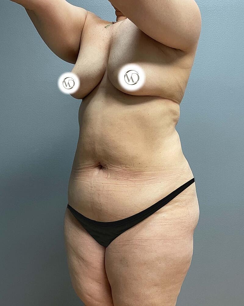 Mommy Makeover Before & After