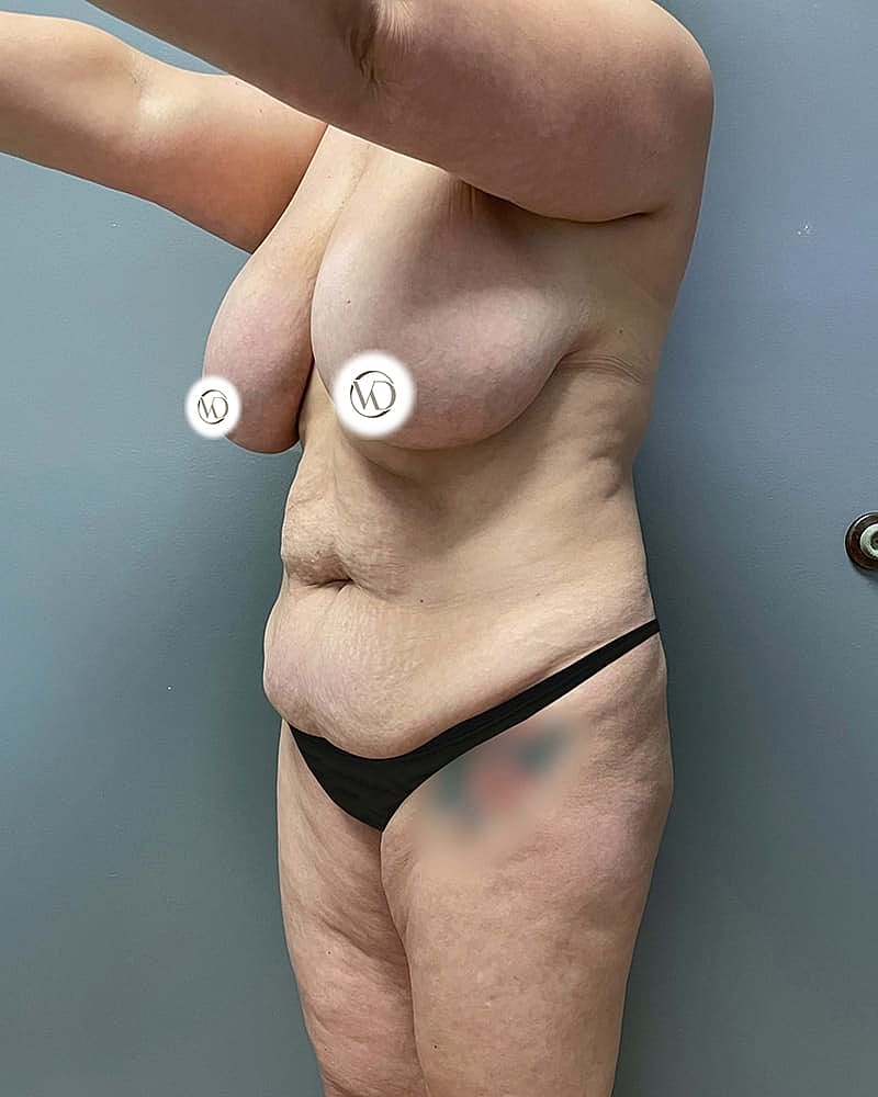Mommy Makeover Before & After