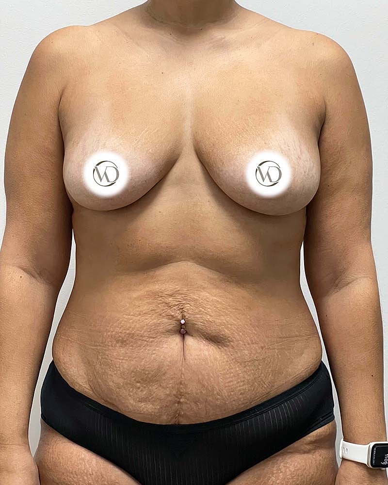 Mommy Makeover Before & After