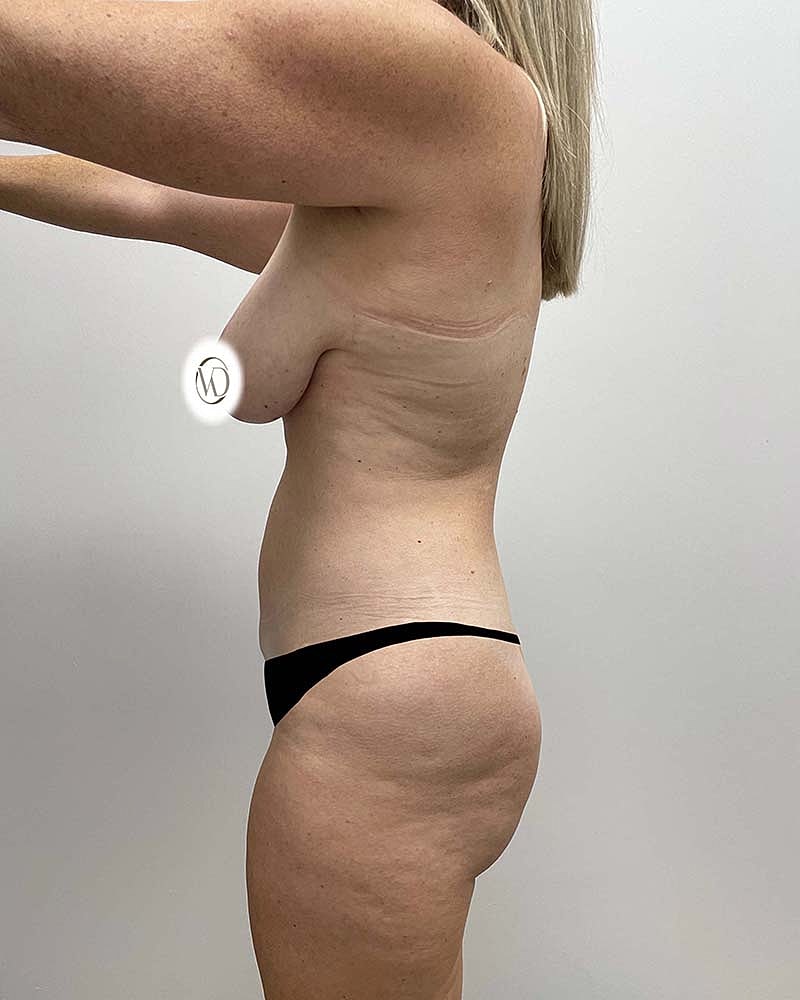 Mini Tummy Tuck Before & After