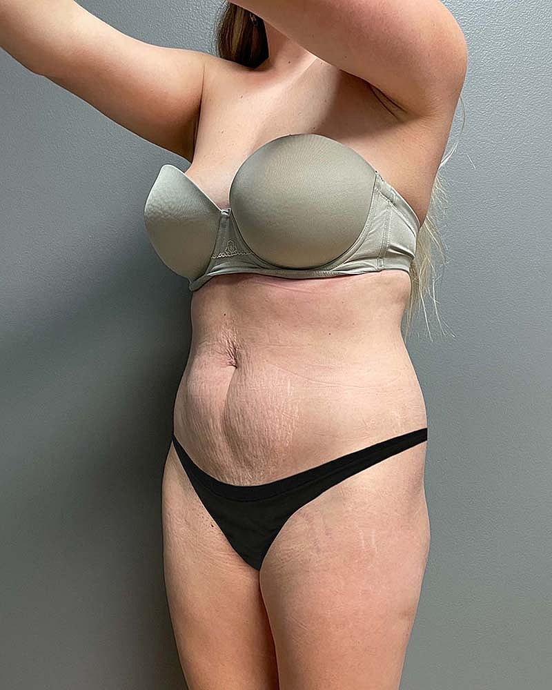 Mini Tummy Tuck Before & After