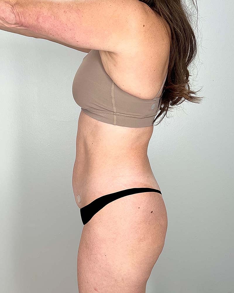 Mini Tummy Tuck Before & After