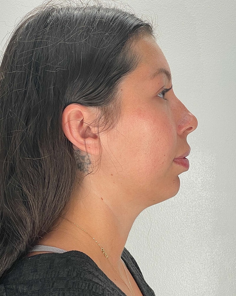 Renuvion Before & After