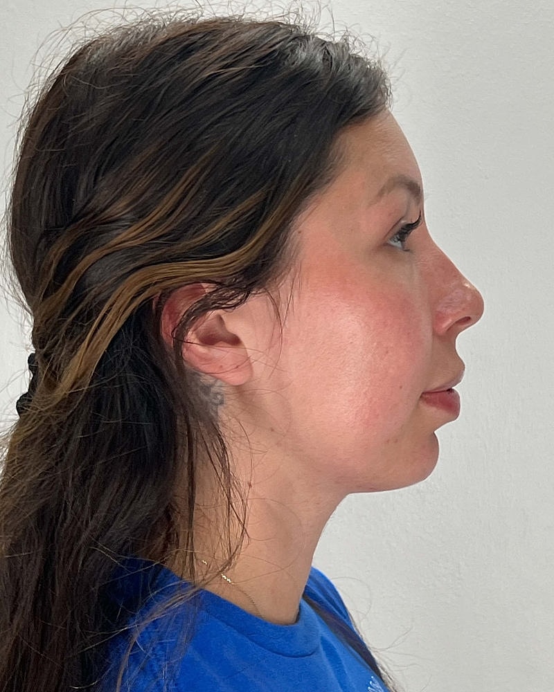 Renuvion Before & After