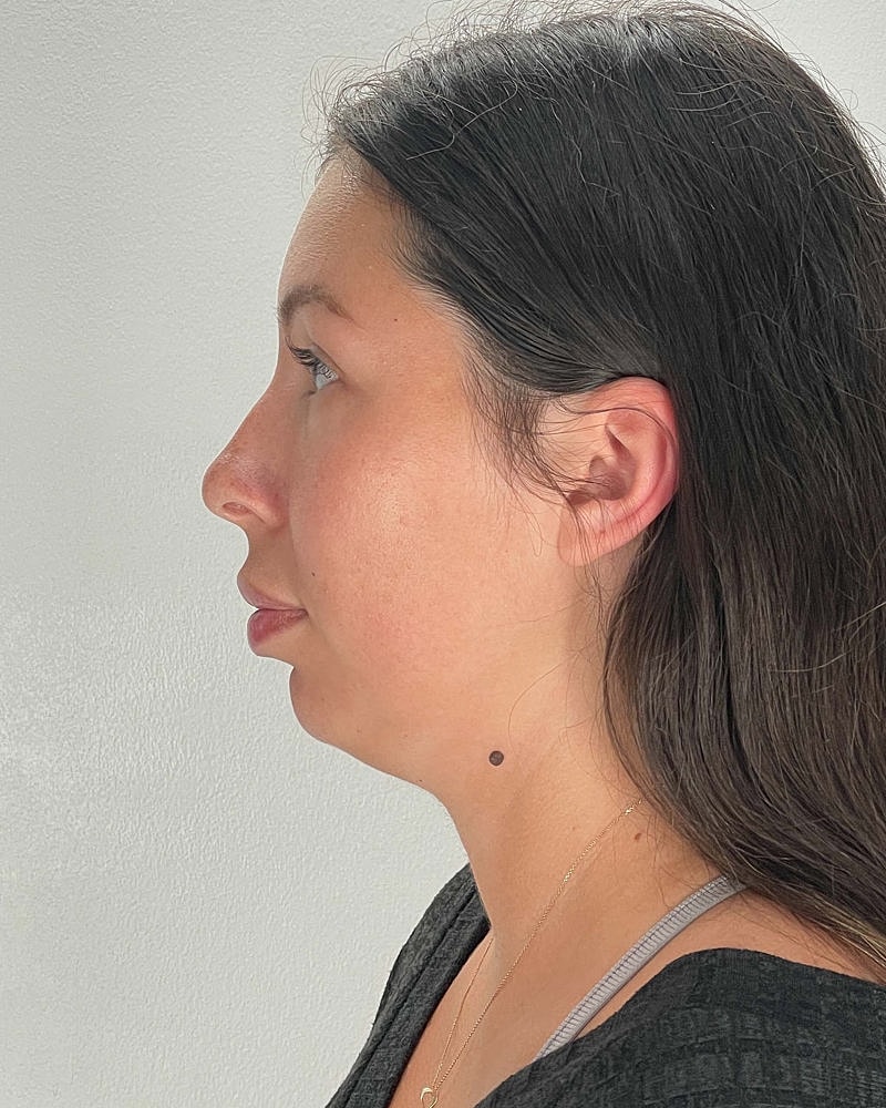 Renuvion Before & After
