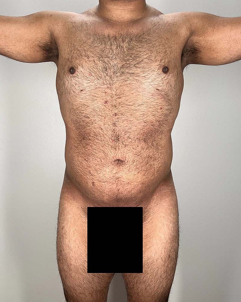 Renuvion Before & After