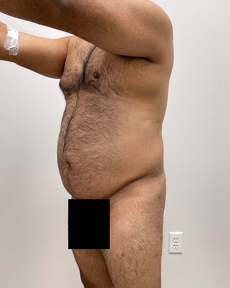 Renuvion Before & After