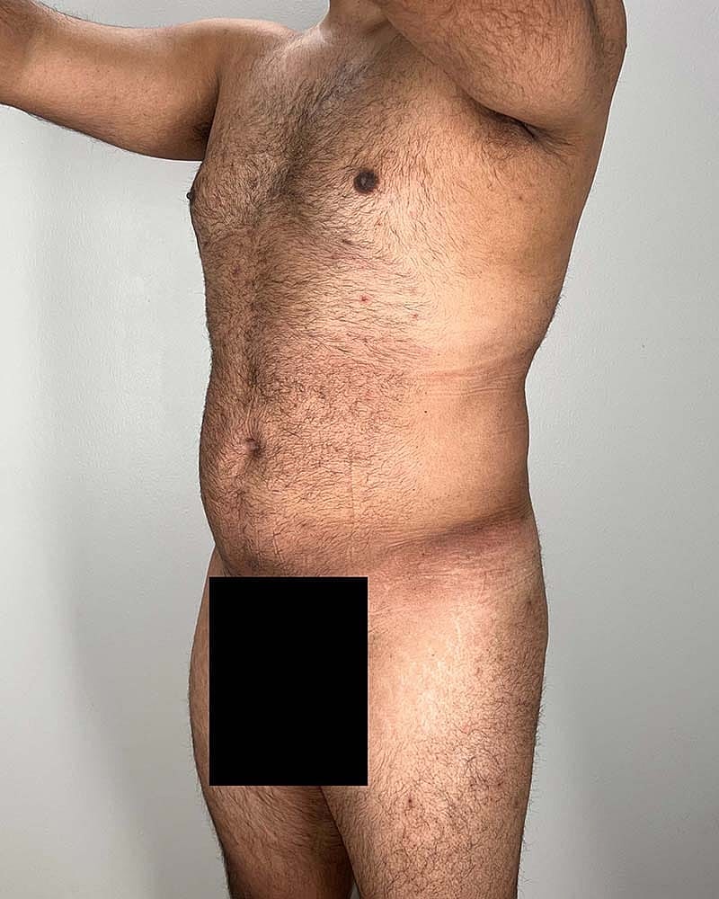 Renuvion Before & After