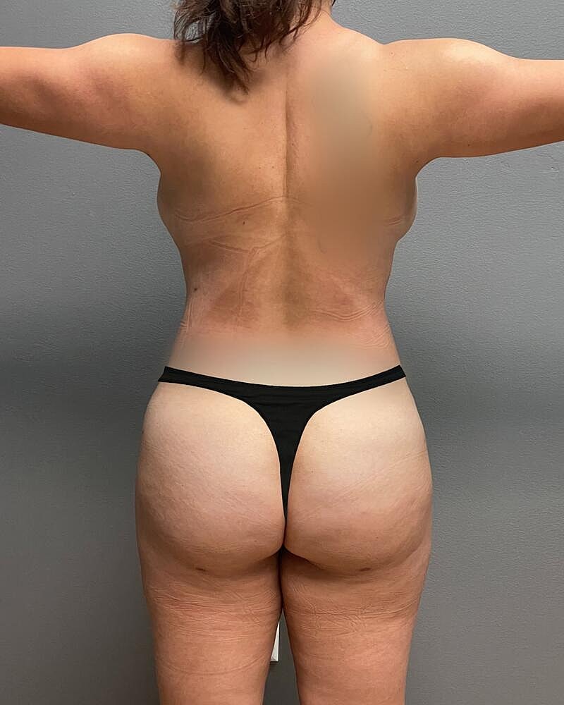 Fat Transfer Before & After