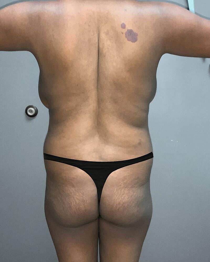 Fat Transfer Before & After