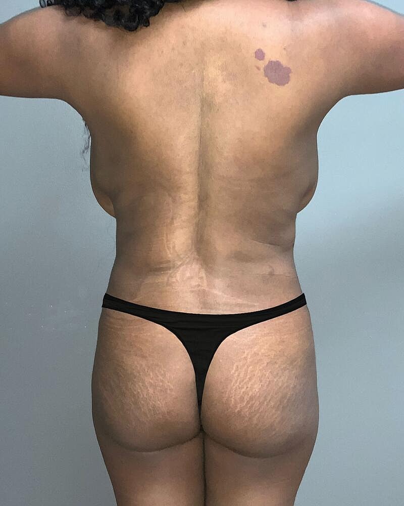 Fat Transfer Before & After