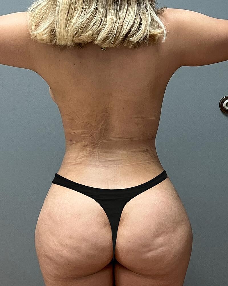 Fat Transfer Before & After
