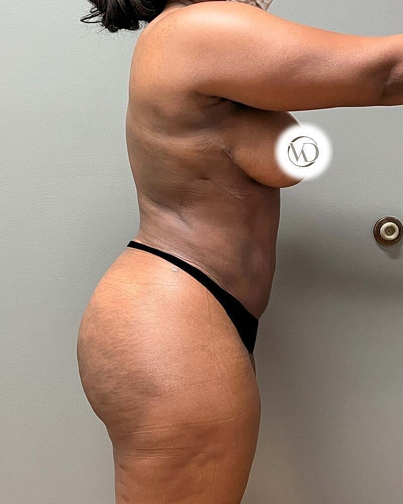 Fat Transfer Before & After