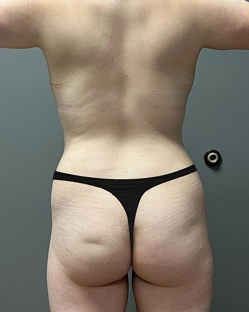 Fat Transfer Before & After