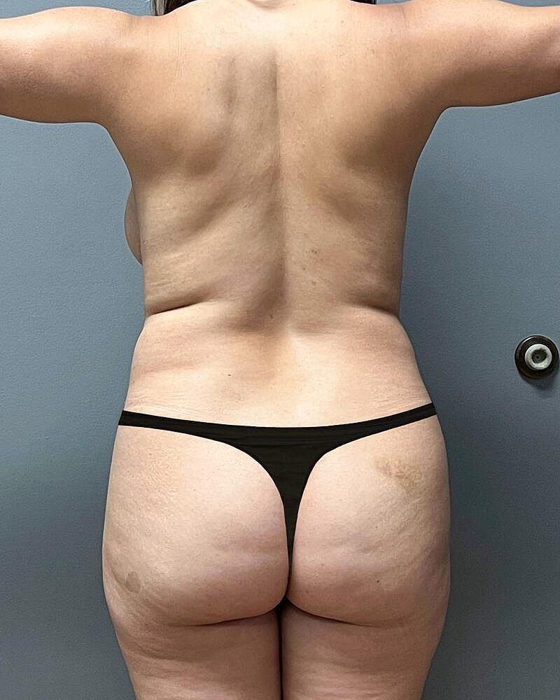 Fat Transfer Before & After