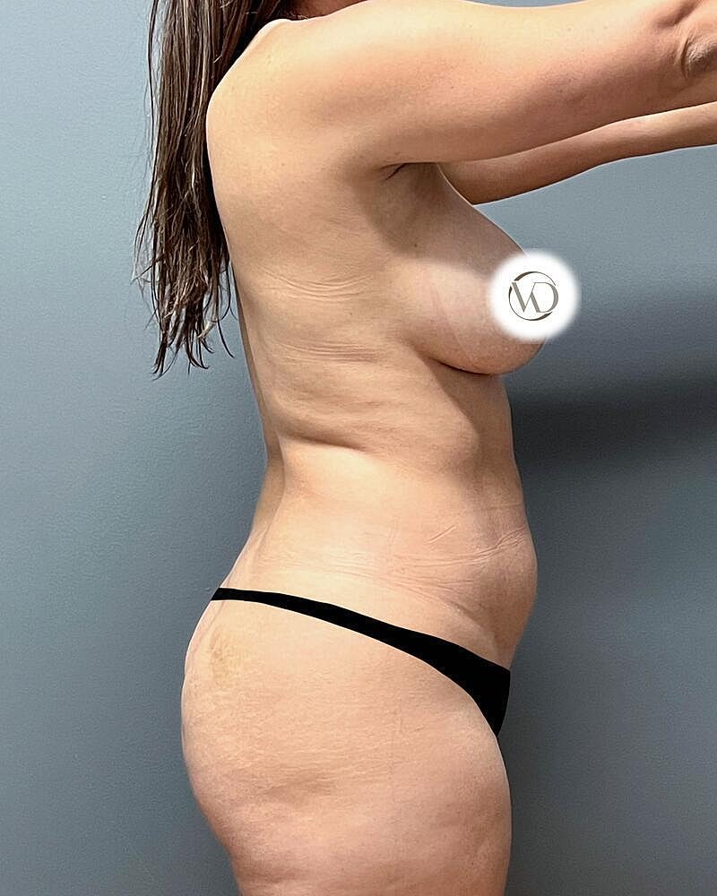 Fat Transfer Before & After