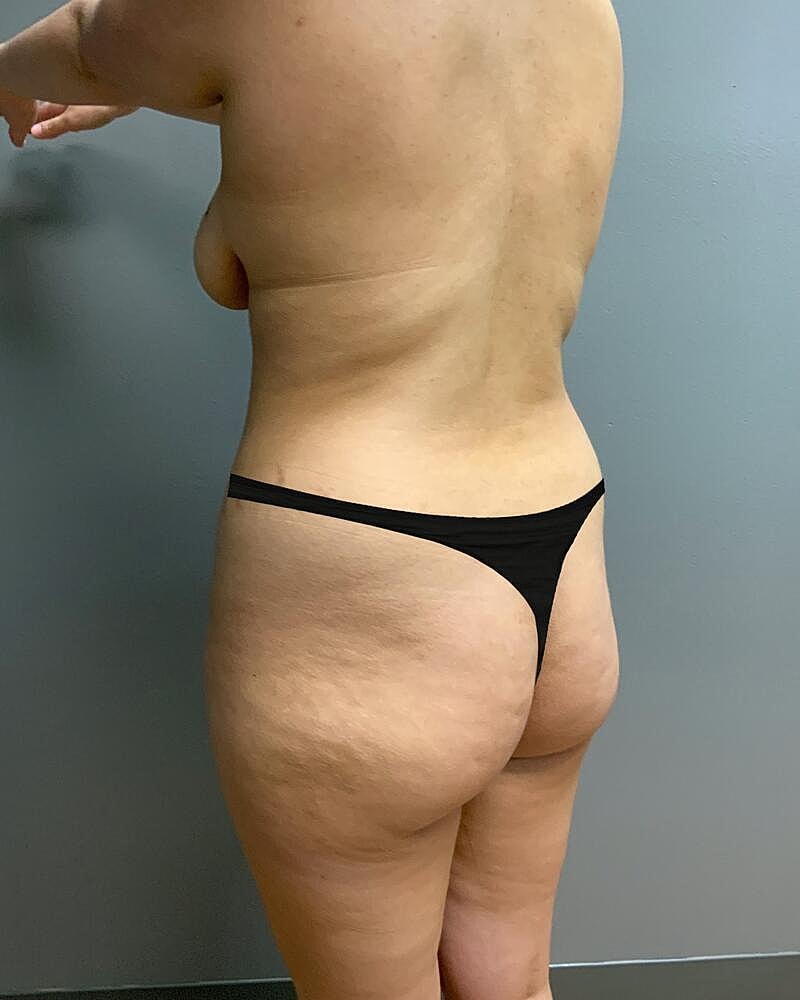 Fat Transfer Before & After