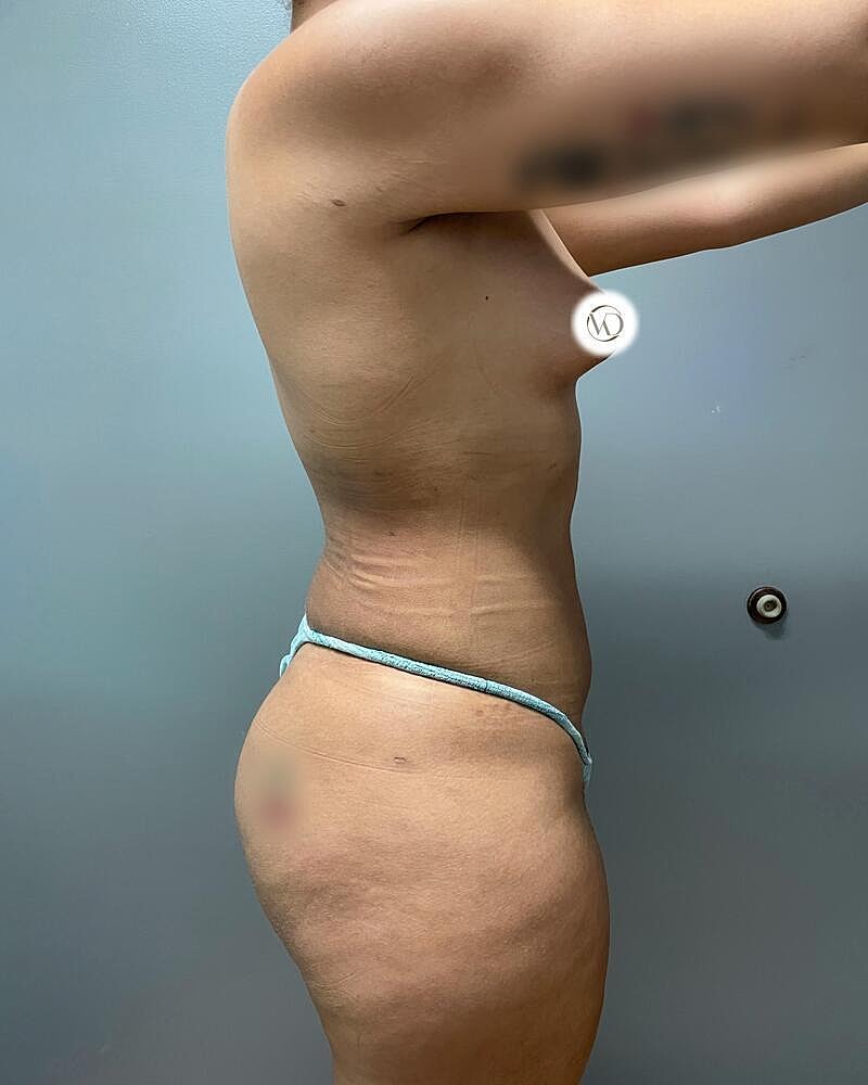 Fat Transfer Before & After