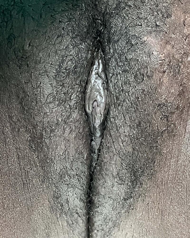 Labiaplasty Before & After
