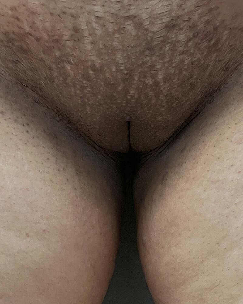 Labiaplasty Before & After